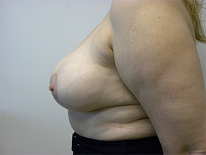 Breast Reduction before and after - after