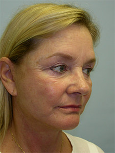 Facelift before and after - after