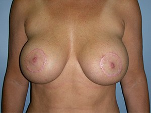 Breast Augmentation before and after - after