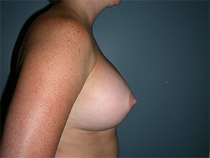 Breast Augmentation before and after - after