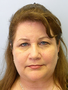 Facelift before and after - after