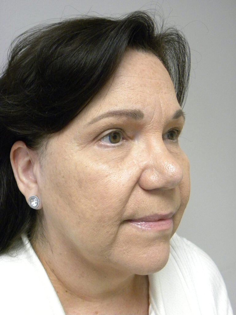 Blepharoplasty before and after - after