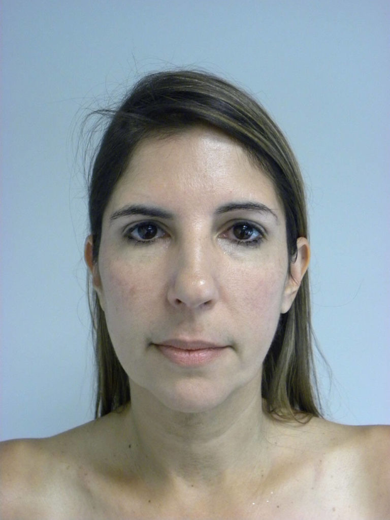 Chin before and after - after