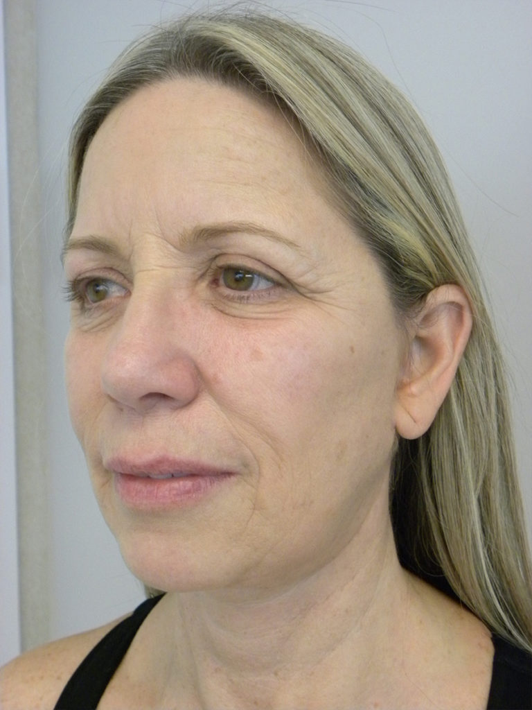 Facelift before and after - after