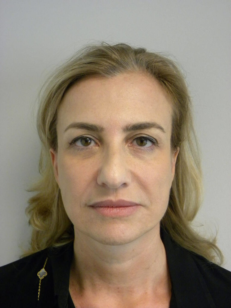 Facelift before and after - after