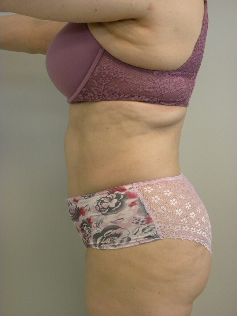 Liposuction before and after - after