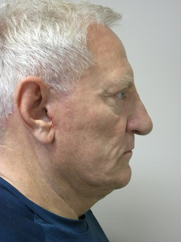 Facelift before and after - after