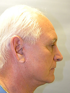 Facelift before and after - after