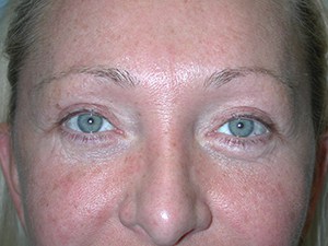 Facelift before and after - after