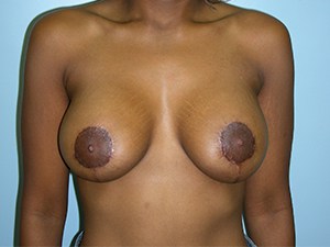 Breast Lift before and after - after