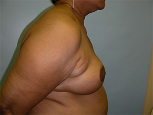 Breast Reduction before and after - after