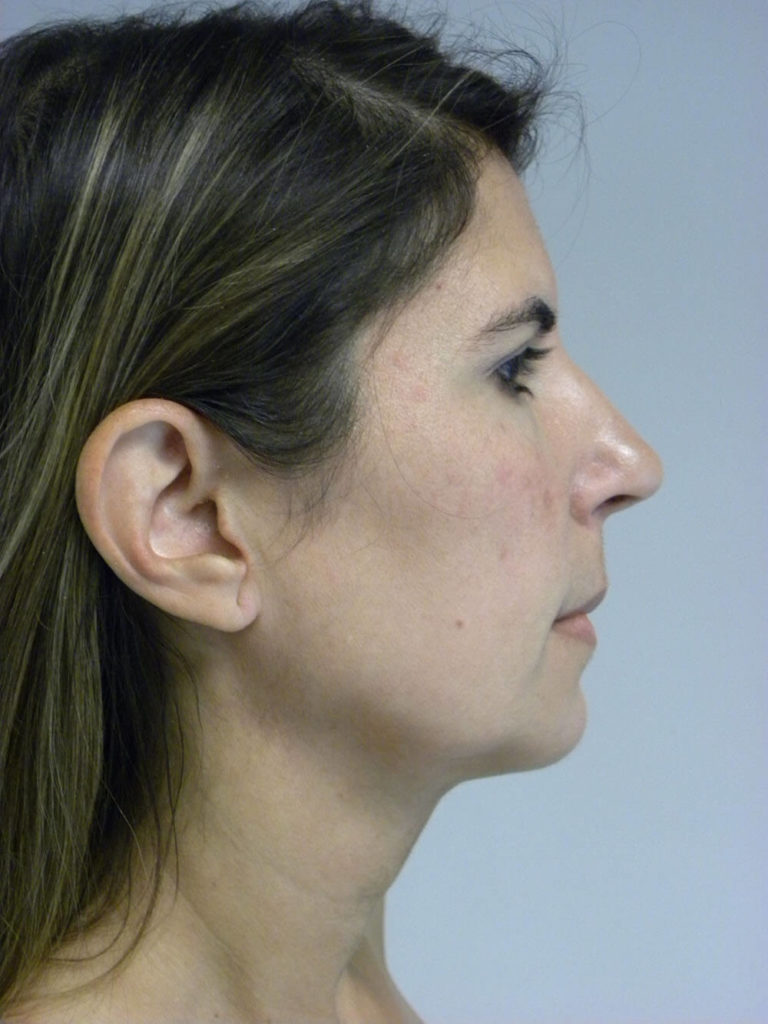 Chin before and after - after