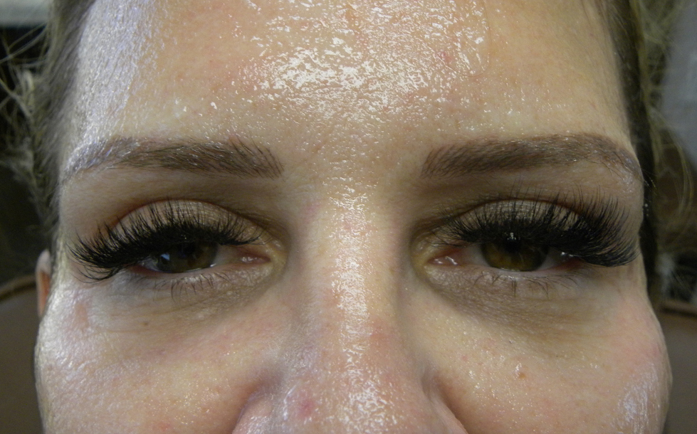 Blepharoplasty before and after - after