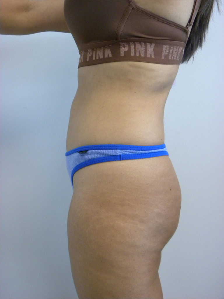 Liposuction before and after - after