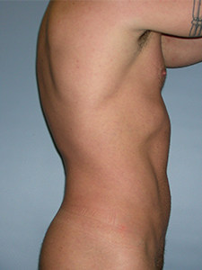 Liposuction before and after - after