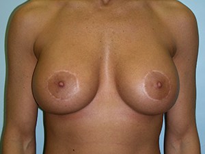 Breast Augmentation before and after - after