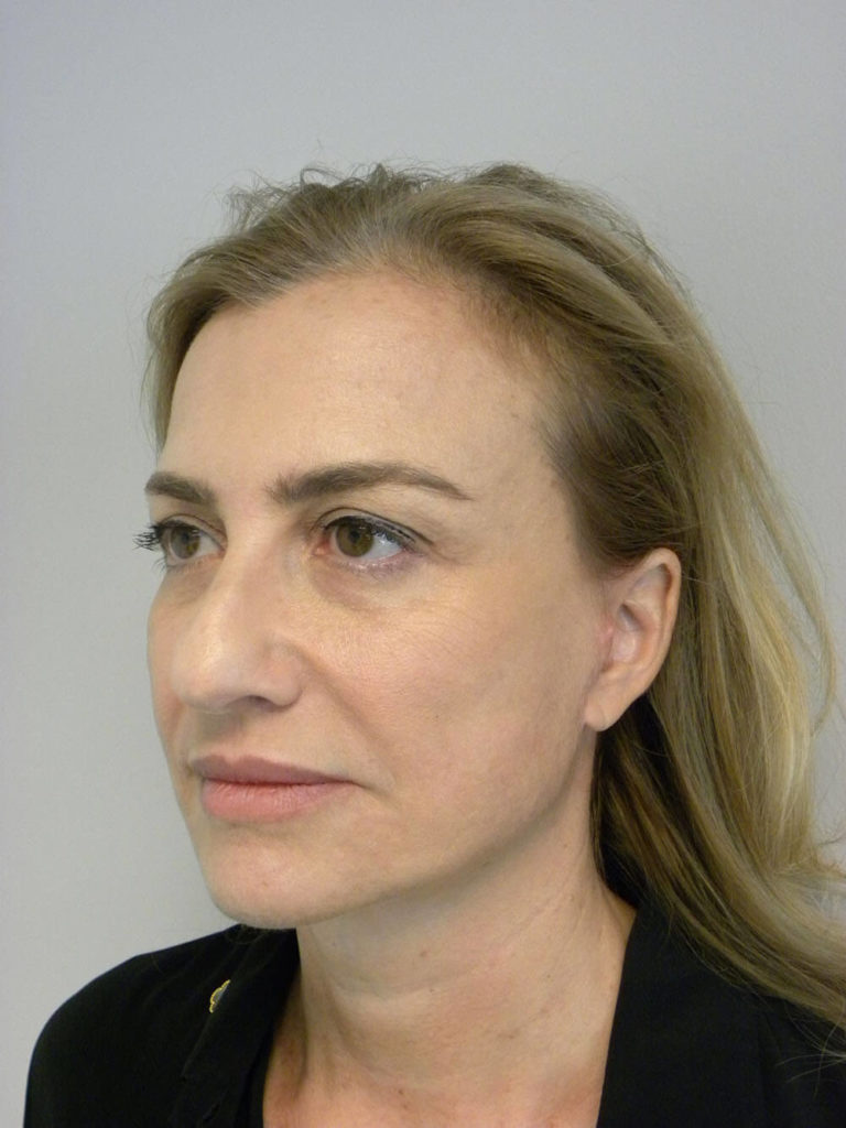 Facelift before and after - after