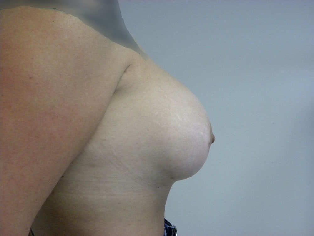 Breast Augmentation before and after - after