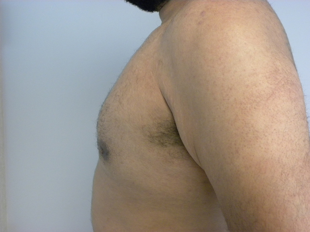 Liposuction before and after - after