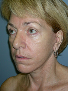 Facelift before and after - after