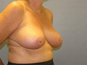 Breast Reduction before and after - after