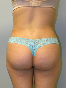 Liposuction before and after - after