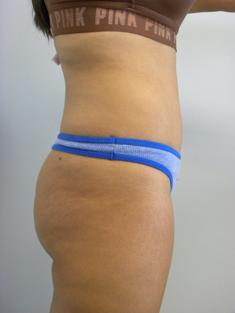 Liposuction before and after - after