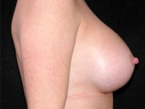 Breast Augmentation before and after - after