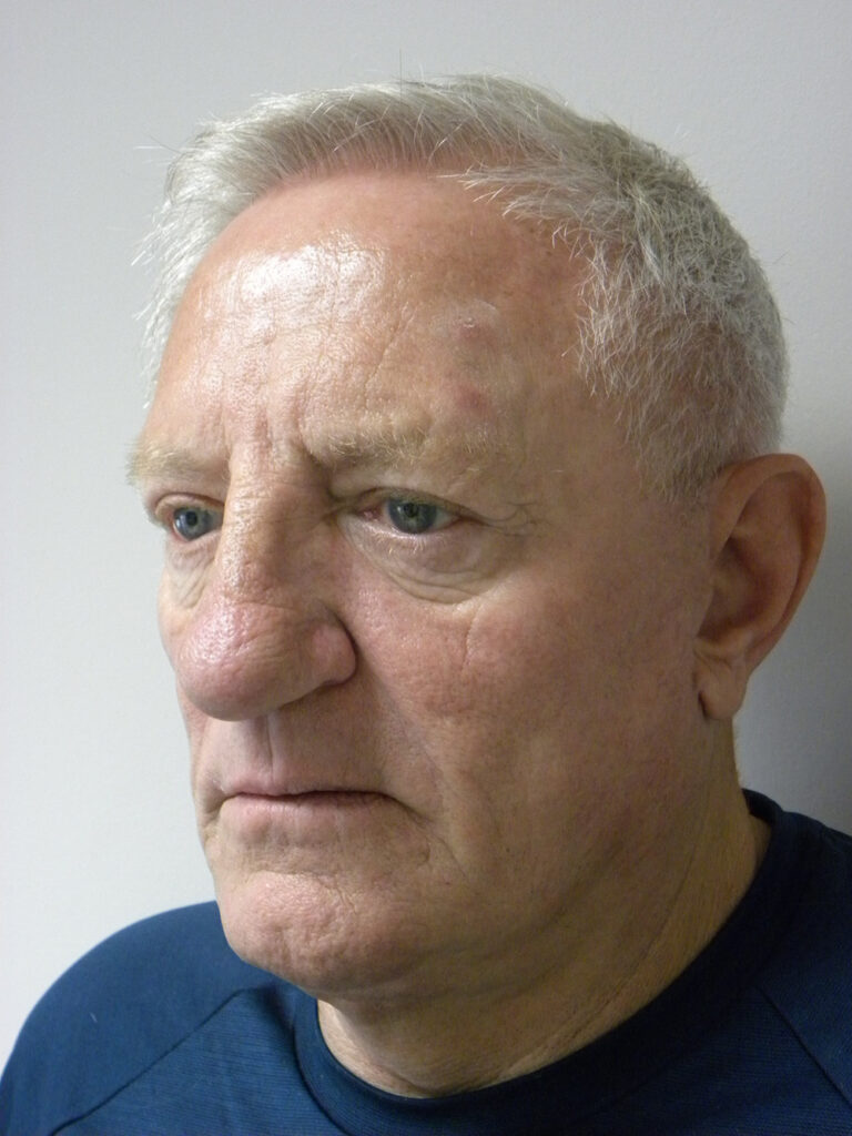 Facelift before and after - after