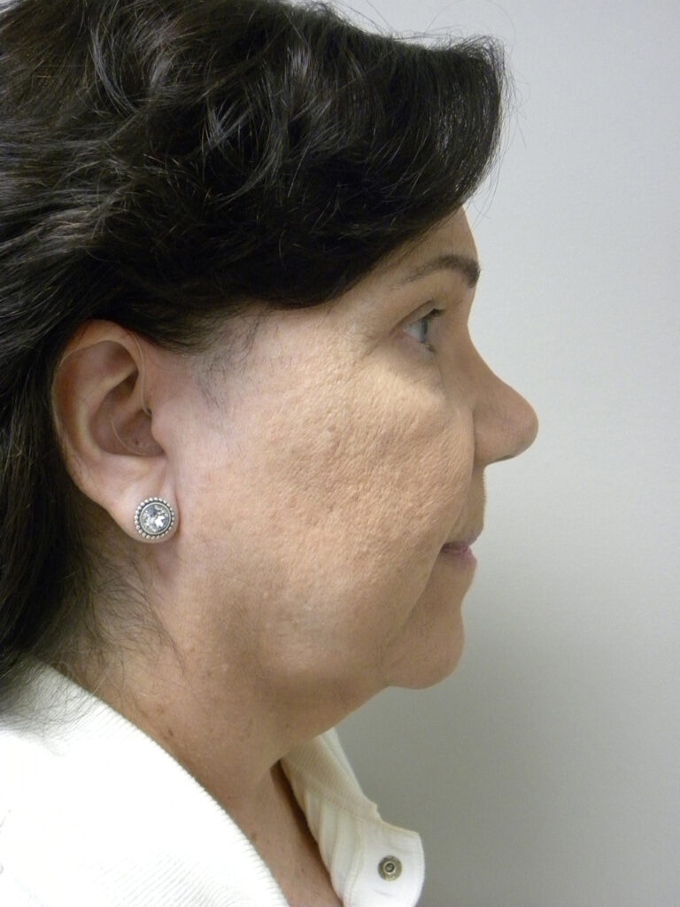 Blepharoplasty before and after - after