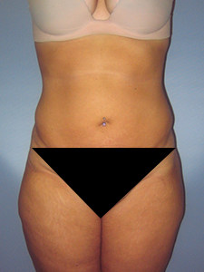 Liposuction before and after - after