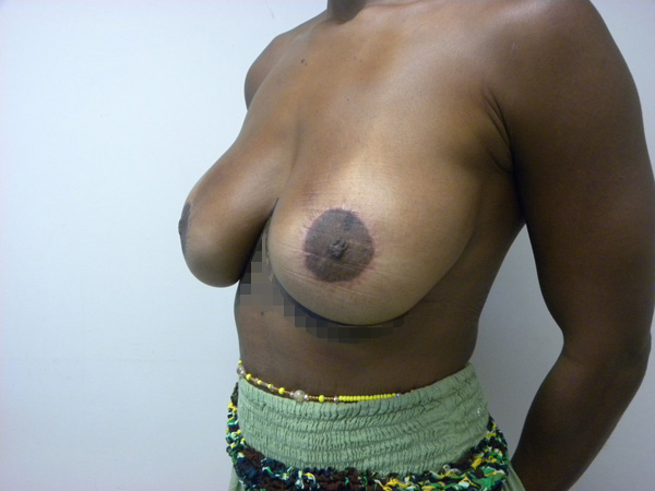 Breast Augmentation before and after - after