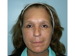 Blepharoplasty before and after - after