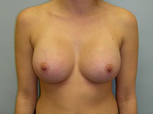 Breast Augmentation before and after - after
