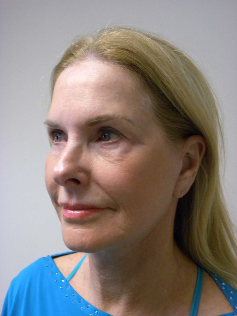 Facelift before and after - after