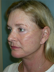 Facelift before and after - after