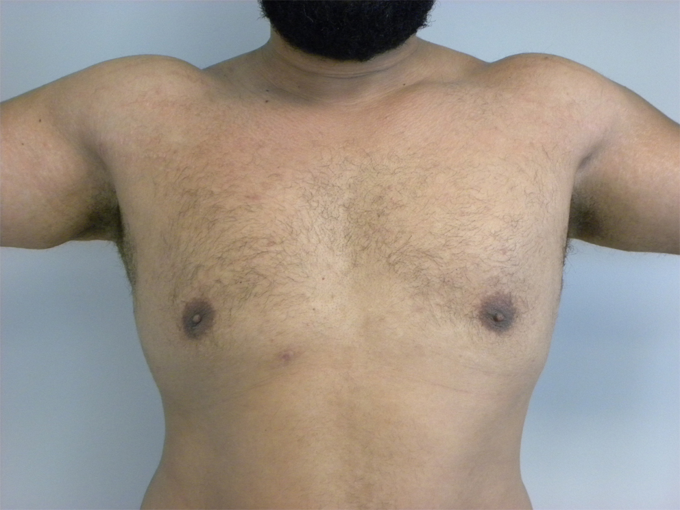 Liposuction before and after - after