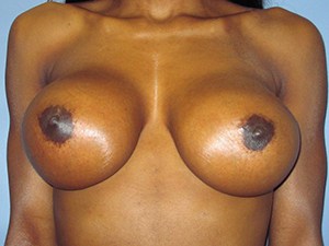Breast Augmentation before and after - after