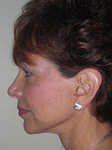 Facelift before and after - after