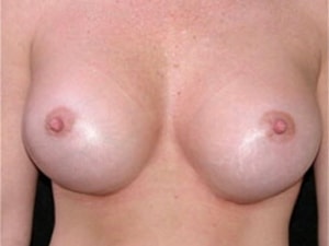 Breast Augmentation before and after - after