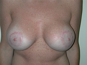 Breast Lift before and after - after