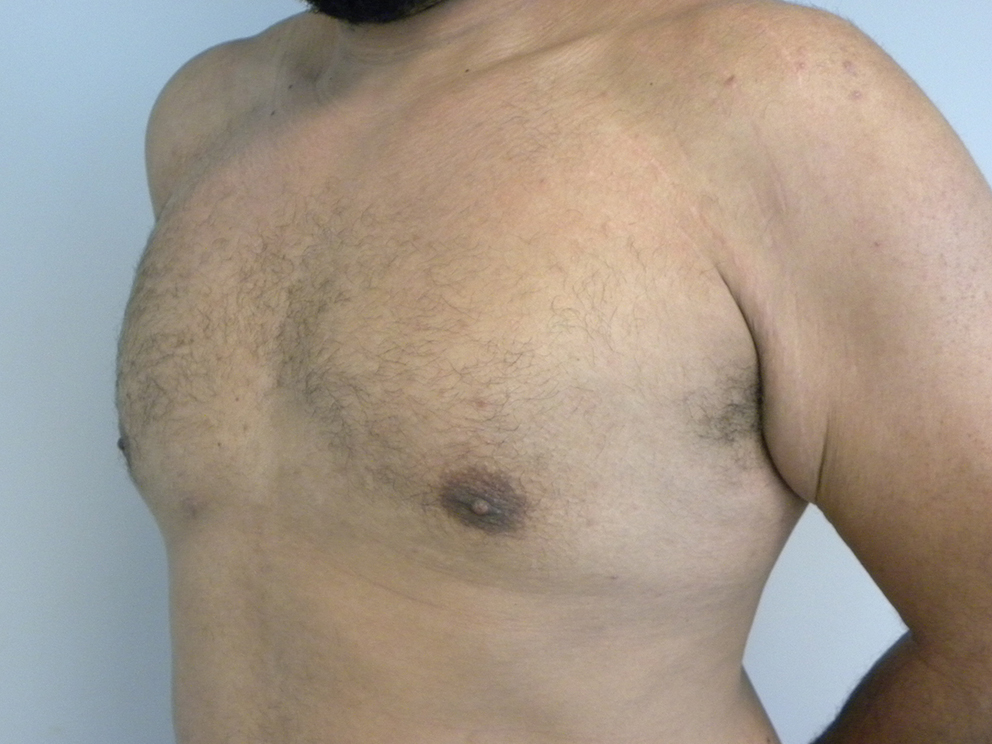 Liposuction before and after - after
