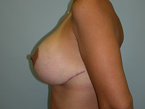 Breast Augmentation before and after - after