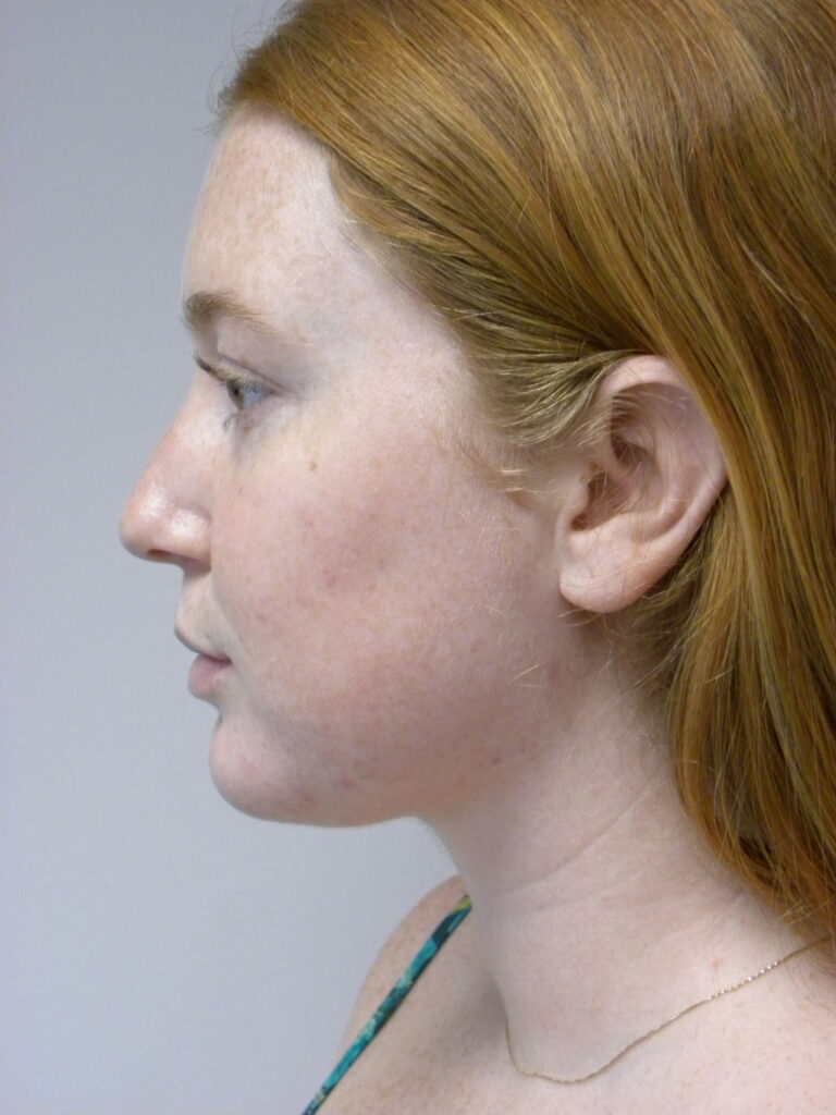 Chin before and after - after