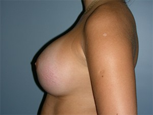 Breast Augmentation before and after - after