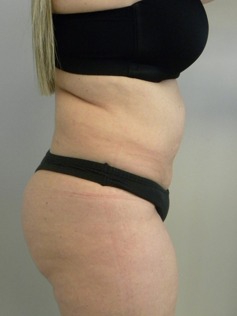 Liposuction before and after - after