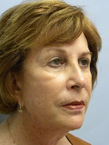 Facelift before and after - after