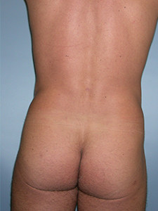Liposuction before and after - after