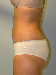 Liposuction before and after - after