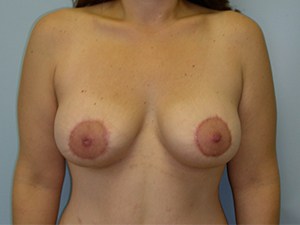 Breast Lift before and after - after